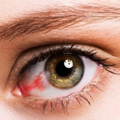 Cirurgia de PterÃ­geo